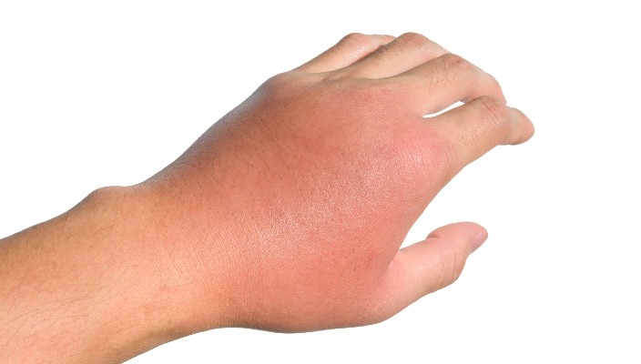A hand that currently has cellulitis.