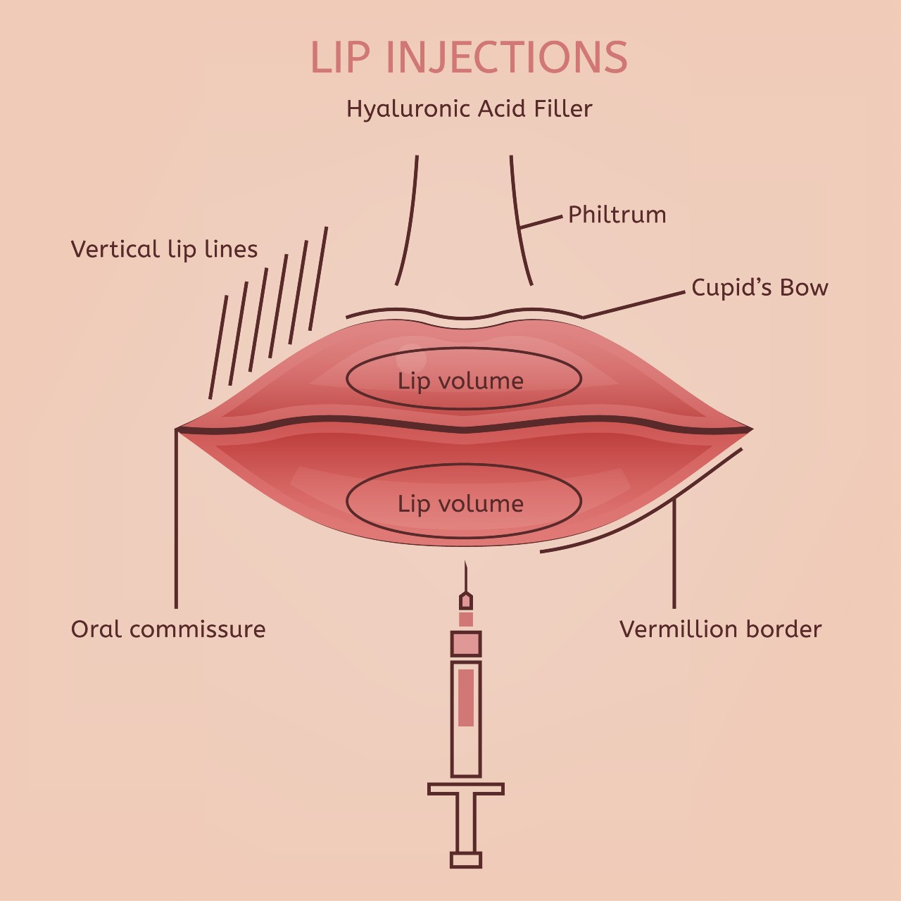 Diagram for lip injections