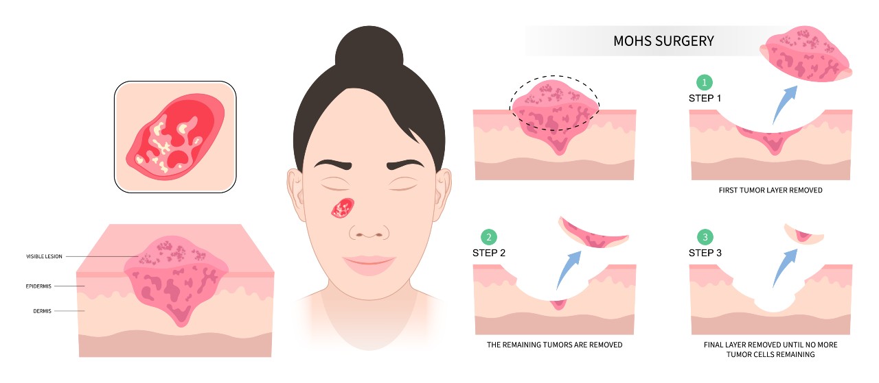 Diagram showing how Mohs surgery works.
