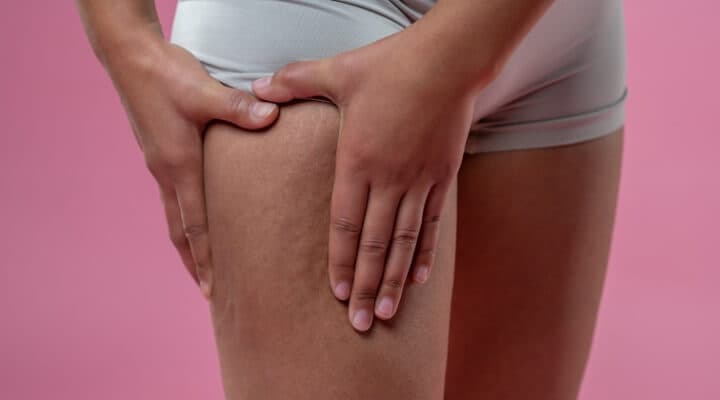 Demystifying Cellulitis: Causes, Symptoms, and Treatment Options