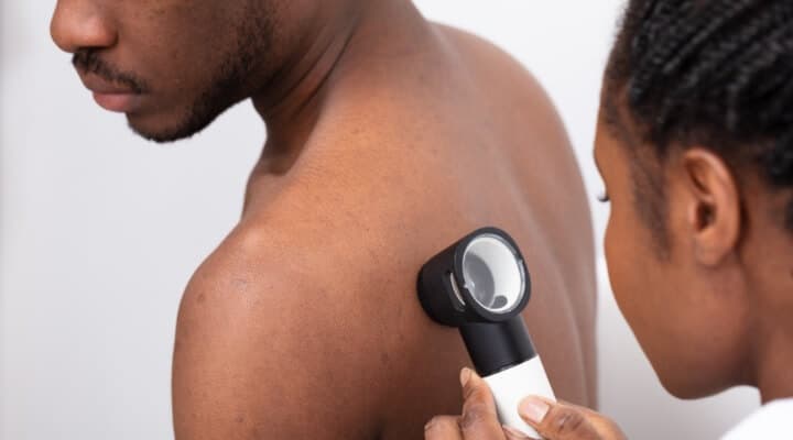 Total Body Skin Exams