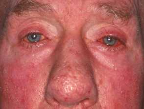 example-of-rosacea-on-face