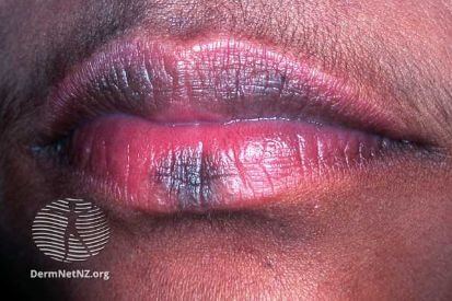 example-of-skin-discoloration-on-lips