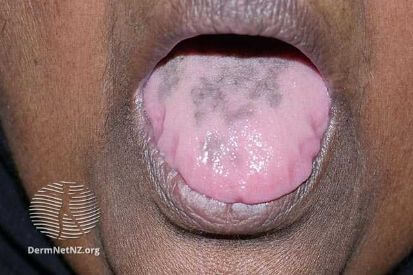 example-of-skin-discoloration-on-tongue