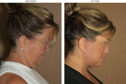 face-lift-before-and-after