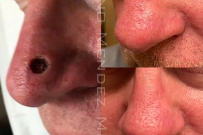 skin-cancer-removal-before-and-after