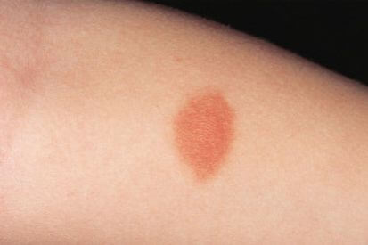 example-of-a-birthmark