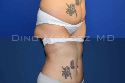 liposuction-before-and-after-stomach