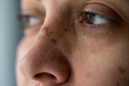 woman-skin-discoloration