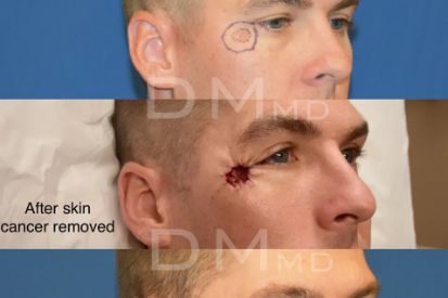 skin-cancer-removal-before-and-after-temple