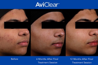 AviClear-before-and-after