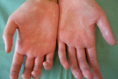 Hyperhidrosis-on-hands