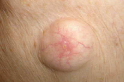 example-of-cyst