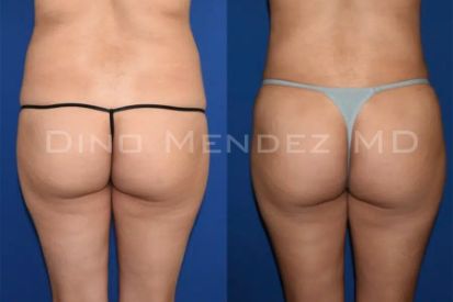 liposuction-before-and-after-butt