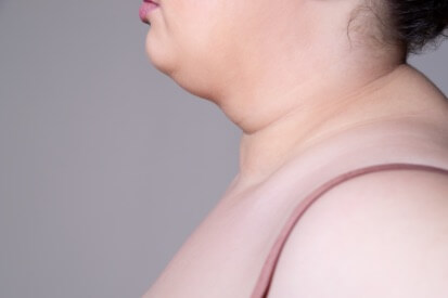 woman-fatty-under-chin
