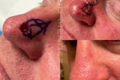 skin-cancer-removal-before-and-after-nose