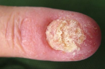fungus-on-finger