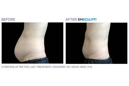 EMSCULPT-NEO-before-and-after