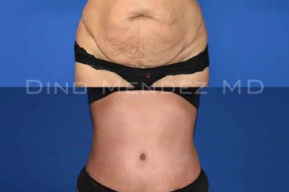 tummy-tuck-before-and-after