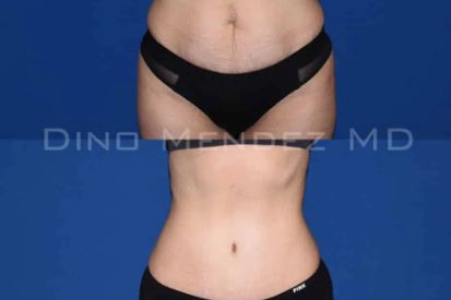 tummy-tuck-before-and-after