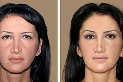 brow-lift-before-and-after