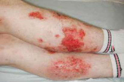 eczema-on-legs