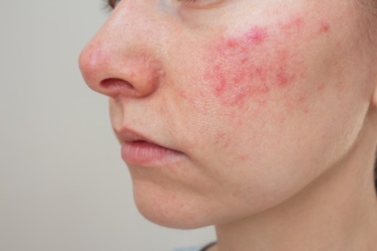 acne-on-cheeks