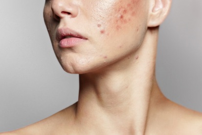 woman-chin-with-acne