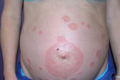 pregnant-woman-with-rash