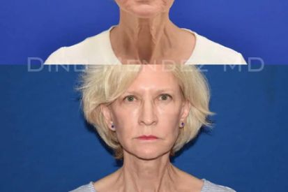 neck-lift-before-and-after
