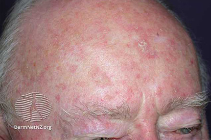 actinic-keratosis-on-head