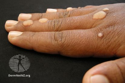example-of-warts
