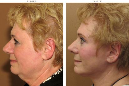 facial-rejuventaiton-surgery-before-and-after