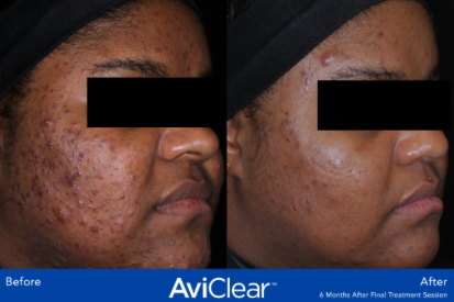 AviClear-before-and-after
