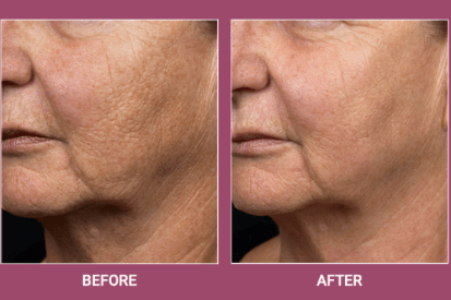 fraxel-laser-before-and-after