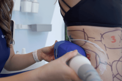 woman-getting-CoolSculpting