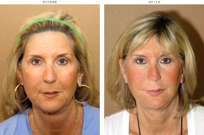 face-lift-before-and-after