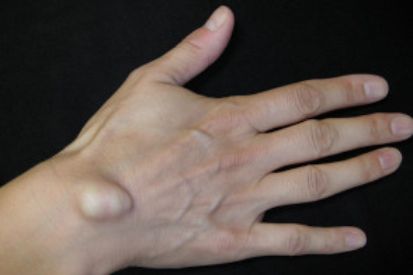 cyst-on-hand