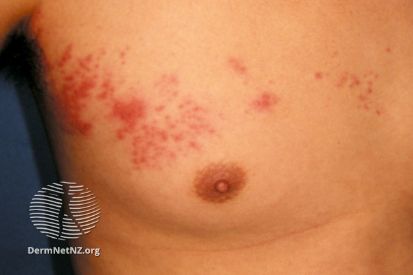 Shingles-example-on-chest
