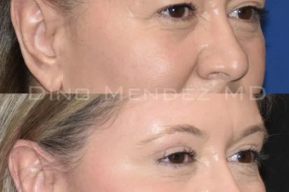 eyelid-surgery-before-and-after