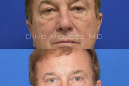eyelid-surgery-before-and-after