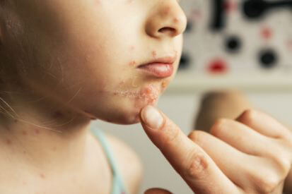 child-with-rash