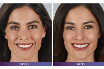 Injectable-Filler-before-and-after