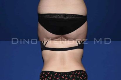 liposuction-before-and-after-butt