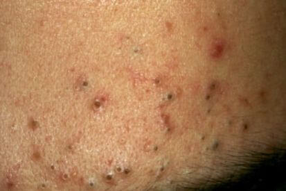 example-of-acne