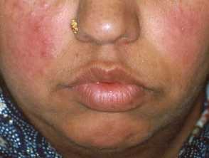 example-of-rosacea-on-face