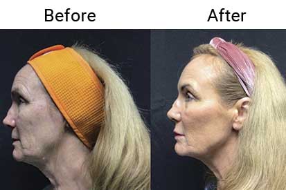 Injectable-Filler-before-and-after
