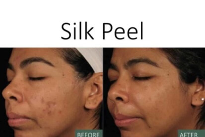 Silk-Peel-before-and-after