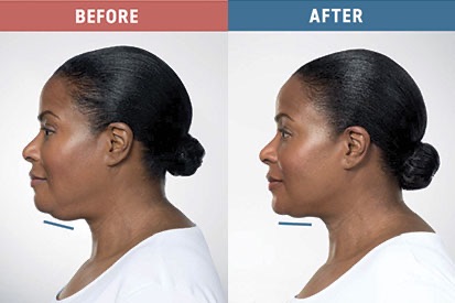KYBELLA-before-and-after