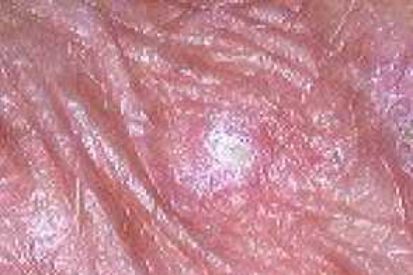 actinic-keratosis-example